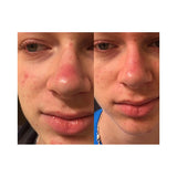 SkinSanity® Acne Treatment - Clear Skin Results Regimen by Best Clean Beauty