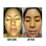 SkinSanity® Acne Treatment - Clear Skin Results Regimen by Best Clean Beauty