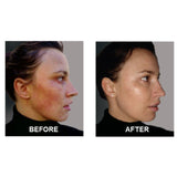 SkinSanity® Acne Treatment - Clear Skin Results Regimen by Best Clean Beauty