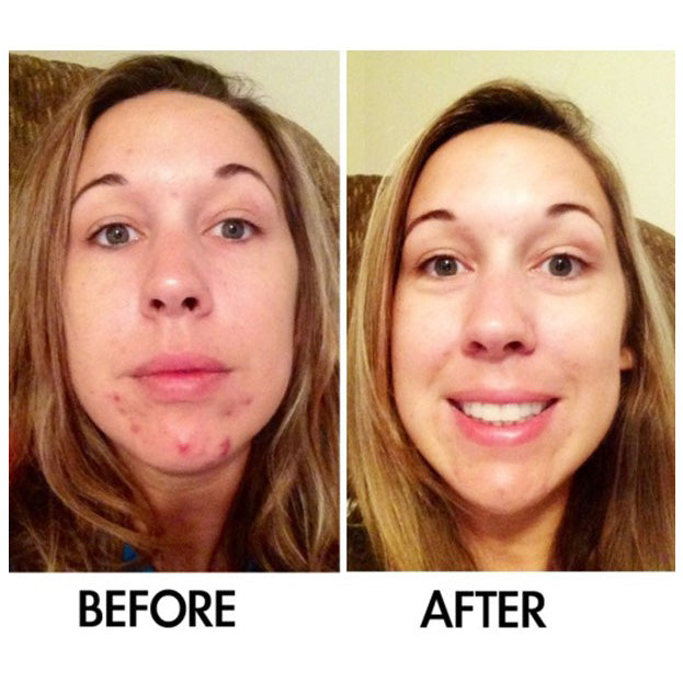 SkinSanity® Acne Treatment - Clear Skin Results Regimen by Best Clean Beauty